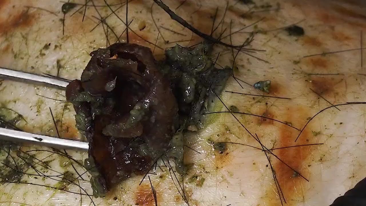 [ASMR] TLC DR LEE&rsquo;S ULTIMATE ZITPOPPER with Tweezer 🌝 とんでもなくJTFG120000