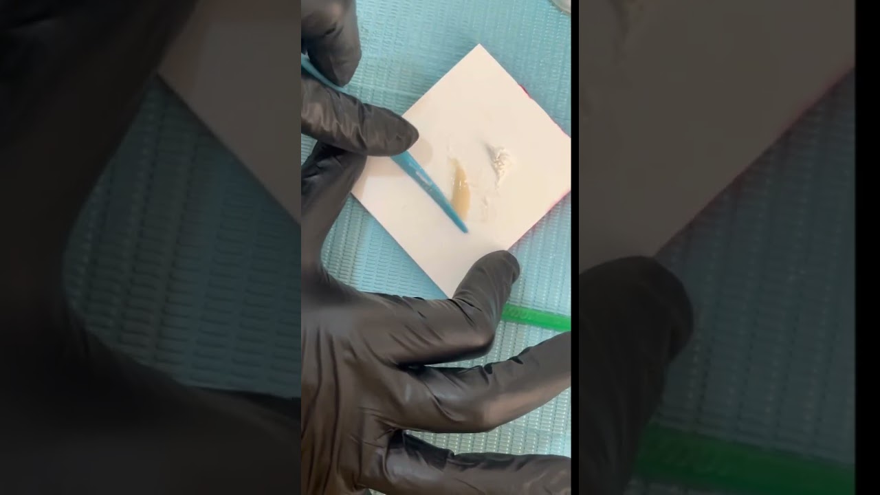 Glass ionomer cement #asthetic #dental #dentalcare #dentistry #esthetician #impression #material