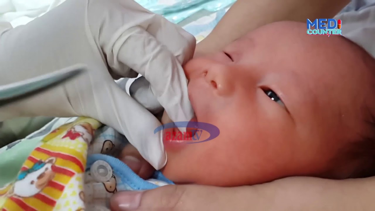MEDICOUNTER - AZAM TV:  Zijue dalili, tiba ya ugonjwa wa Tongue-tie (Udata) kwa mtoto