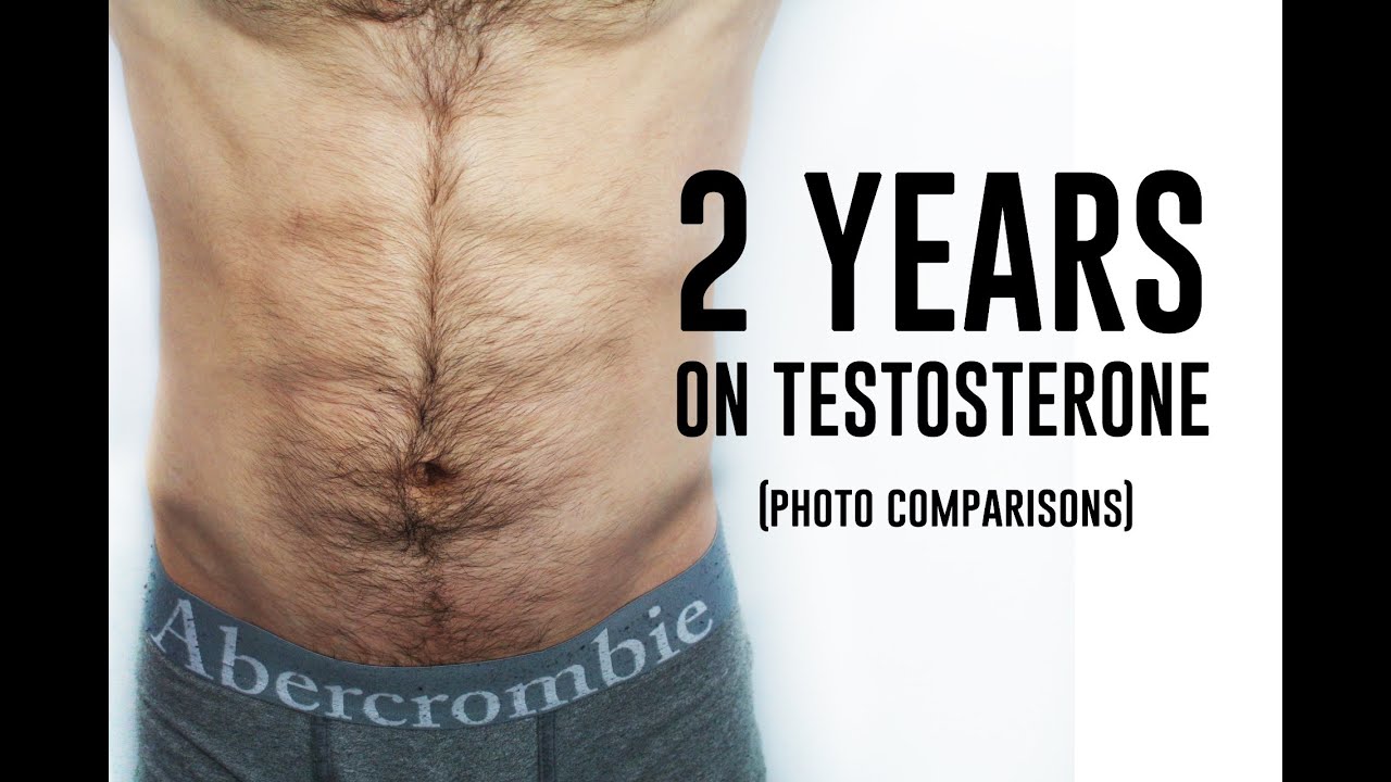 Female to Male Transgender - 2 Years on Testosterone (Photo Comparison)