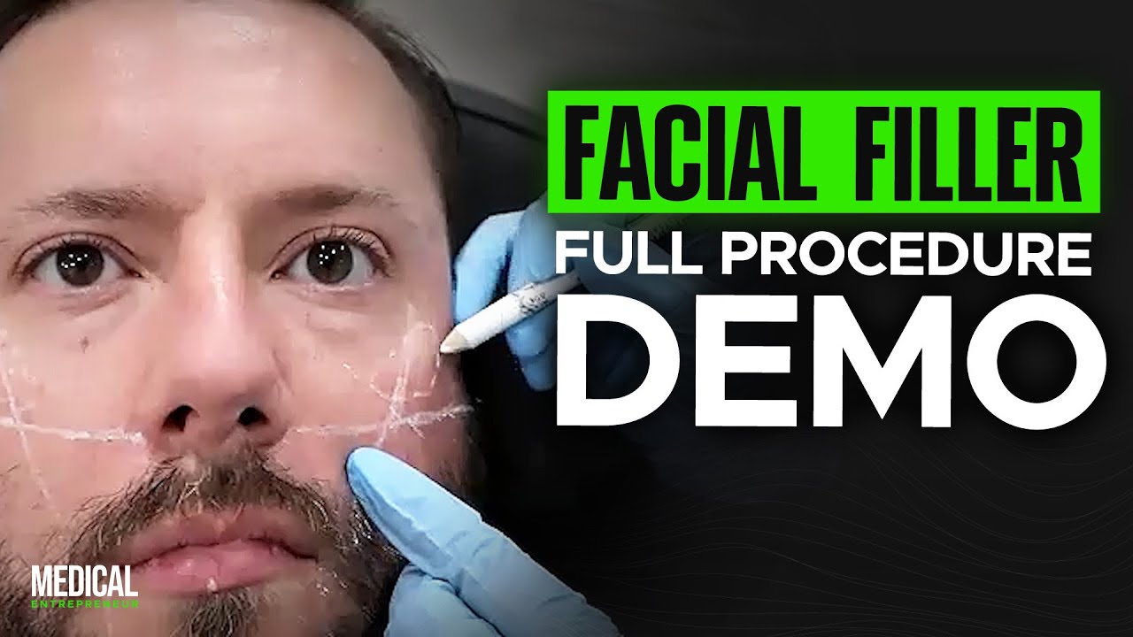 Performing a Dermal Filler Procedure on a Male Patient (Step-By-Step Guide)