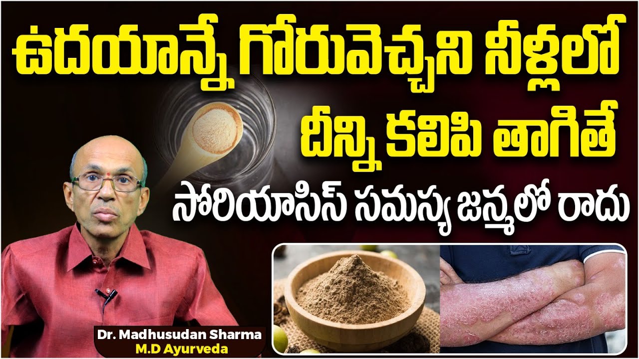 సోరియాసిస్ || Home Remedies for Psoriasis on Skin Problems in Telugu || Dr C Madhusudhan Sharma