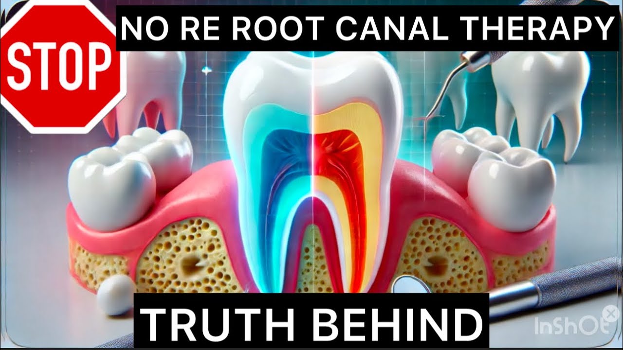 |re root canal treatment or extraction|re root canal treatment|re Rct|