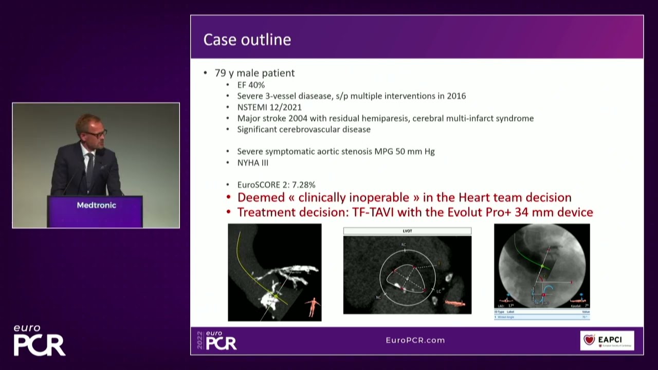 Your most challenging TAVI cases - Achieving precision & control with Evolut platform - EuroPCR 2022