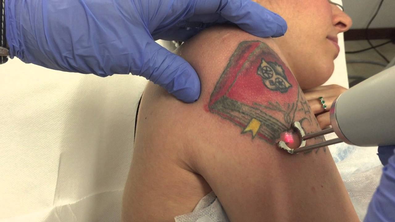 Rimozione laser tatuaggio colorato, Oristano 1a seduta