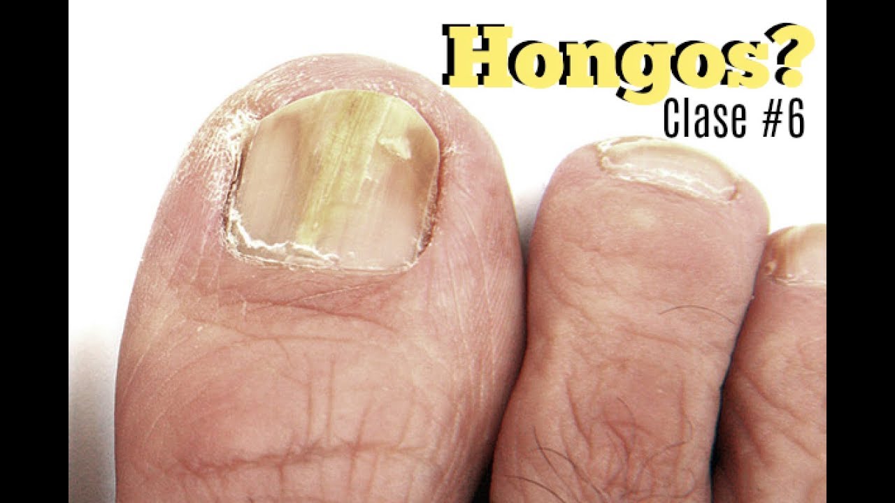 Clase #6 Hongos en las uñas ♥ Deko Uñas