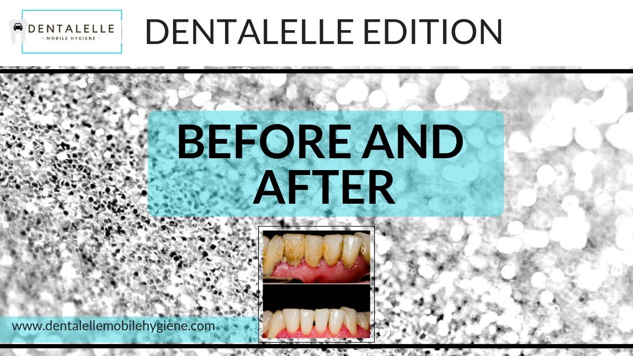 Before and After a Teeth Cleaning - Dentalelle Edition