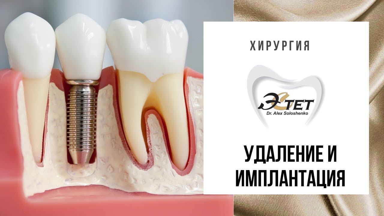 Удаление и имплантация зубов - Стоматология  