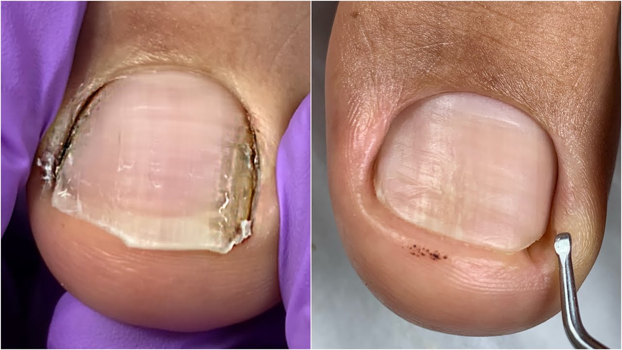 Que ha pasado con la uña? 😱 | el resultado después de 5 meses ☑️