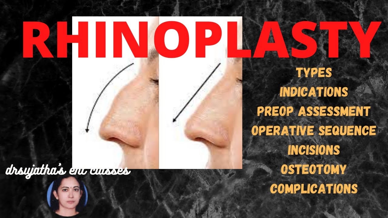 145.Rhinoplasty Surgery : Part 1/2 #nosejob #surgeryeducation