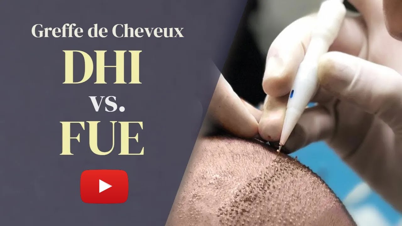 Greffe de cheveux DHI ou FUE : Quel est le meilleur choix en 2023 ?
