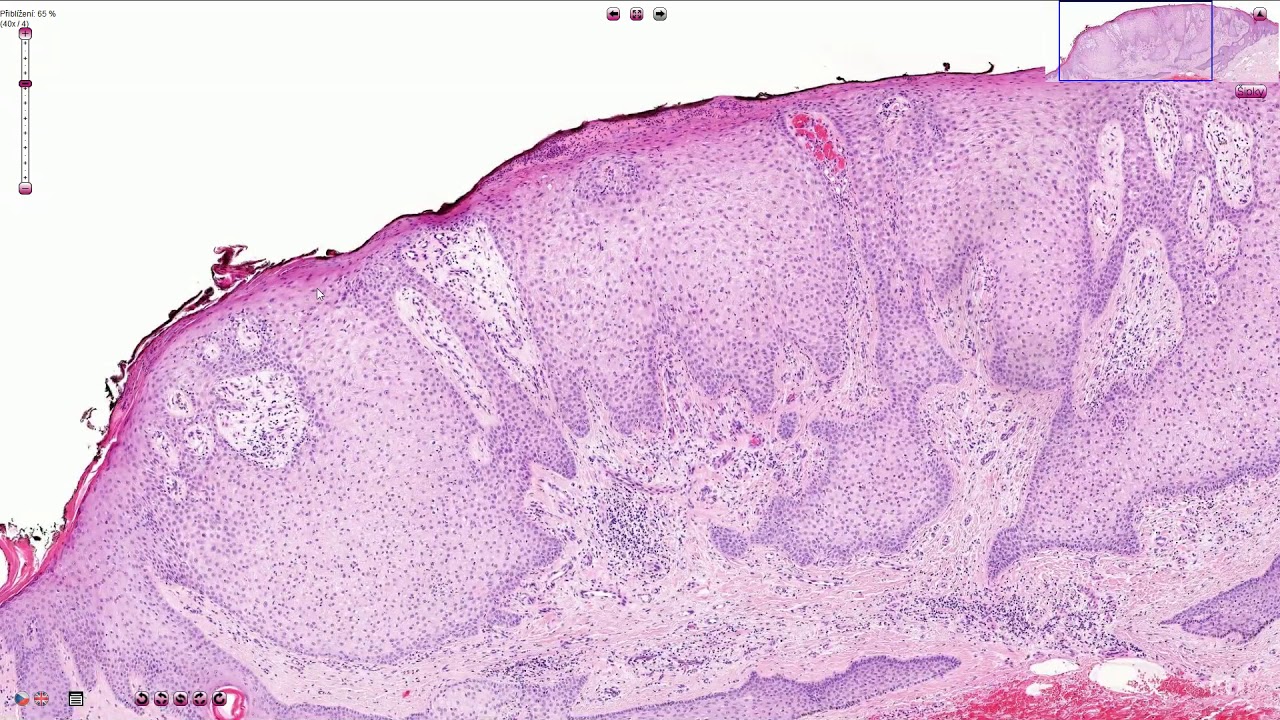 Clear Cell Acanthoma - Skin, Histopathology