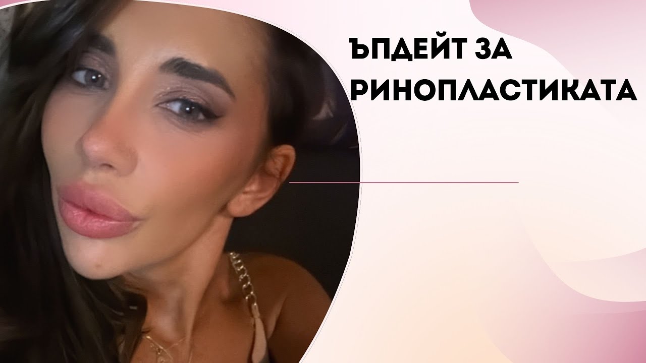 4 месеца след ринопластиката