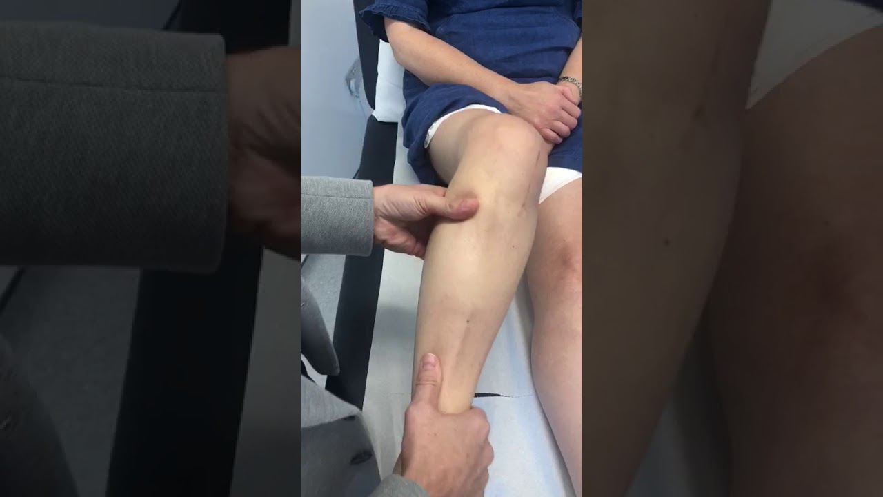 Mrs ZM 14 weeks after internal bracing to the ACL, MCL AND PCL