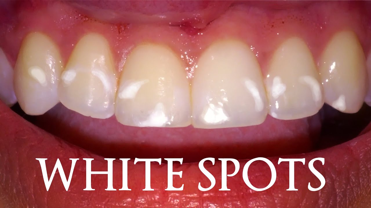 How A Dentist Removes White Spots On Teeth From Braces! Treatment to Get Rid of Remineralized Stains