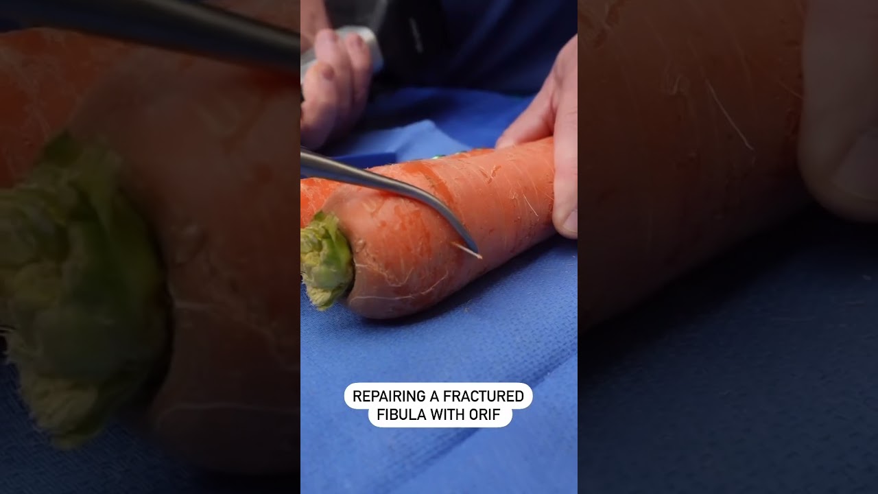 Repairing a Fractured Fibula with ORIF- Dr. Bernstein