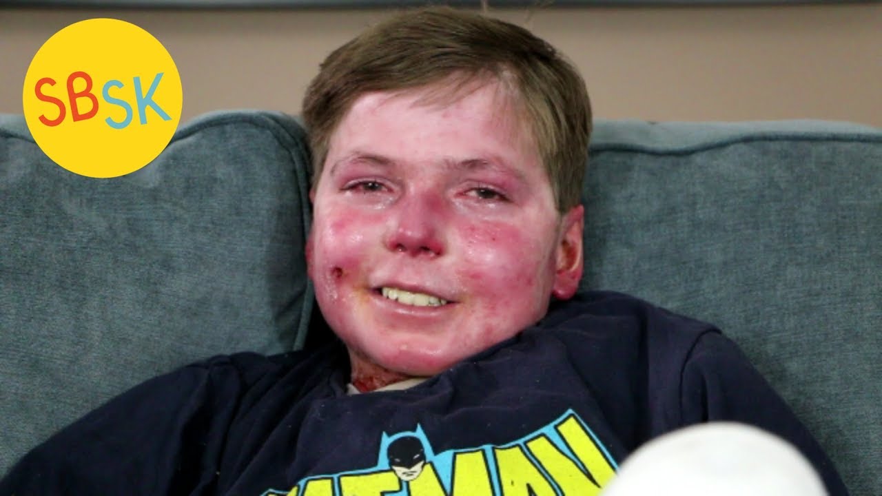 Living in a Body of Open Wounds with Less than Half His Skin (John Hudson - Epidermolysis Bullosa)