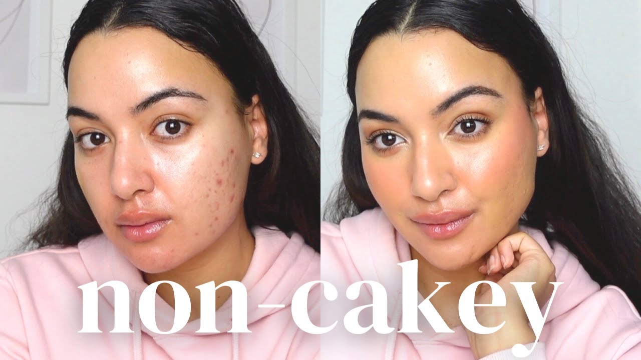 Clean girl Acne, scars and post inflammatory hyperpigmentation | natural, non-cakey makeup coverage.