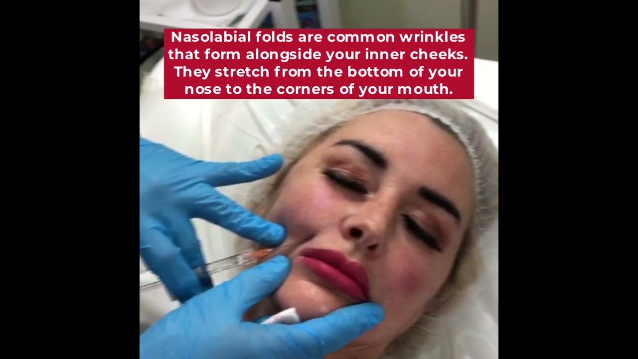 Nasolabial folds with dermal fillers