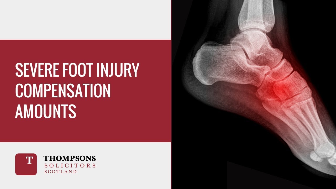 Severe Foot Injury Compensation Amounts