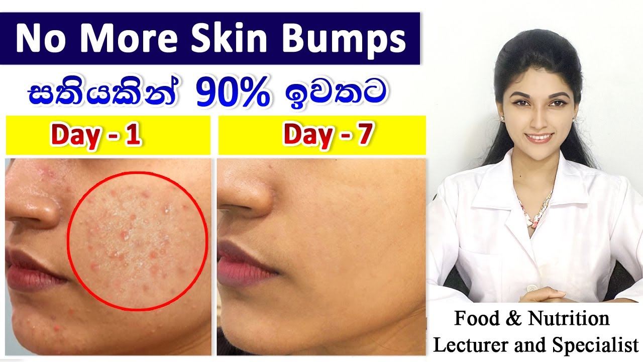 Best Treatment for Oily Skin Bumps with Scientific Explanation | Magical Results|Just one ingredient