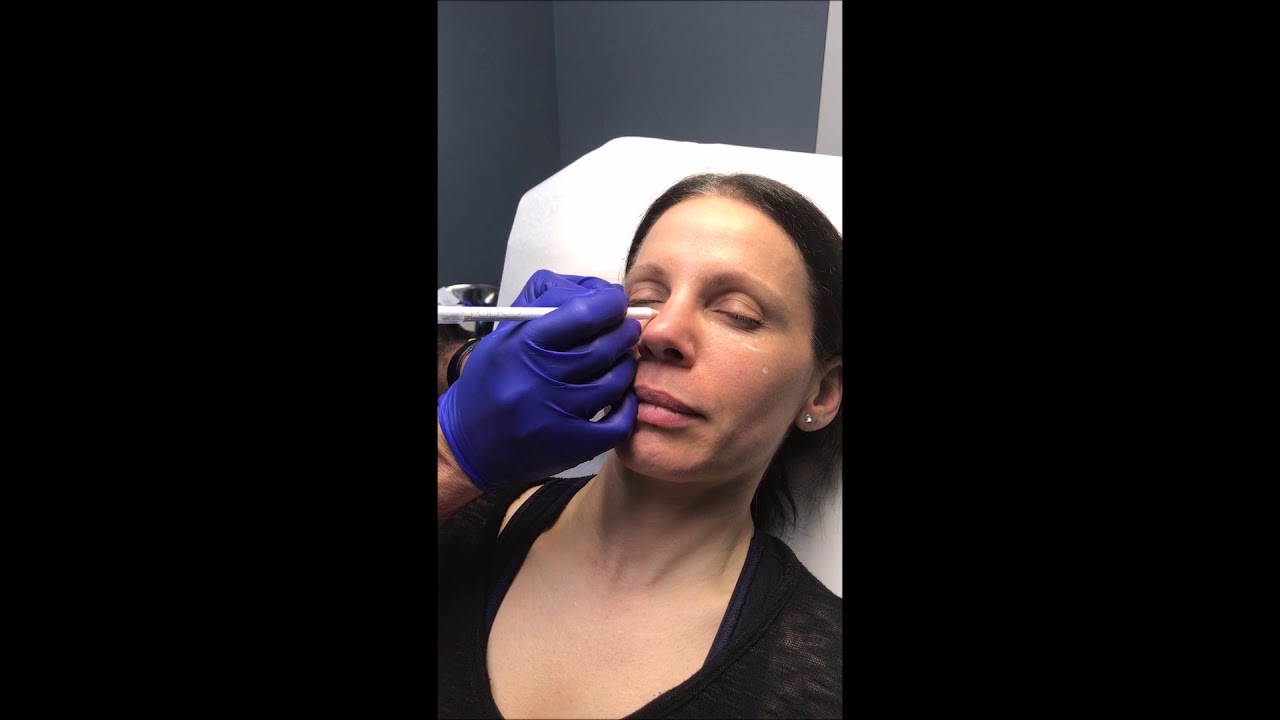 Tear Trough Injections with Juvederm Volbella