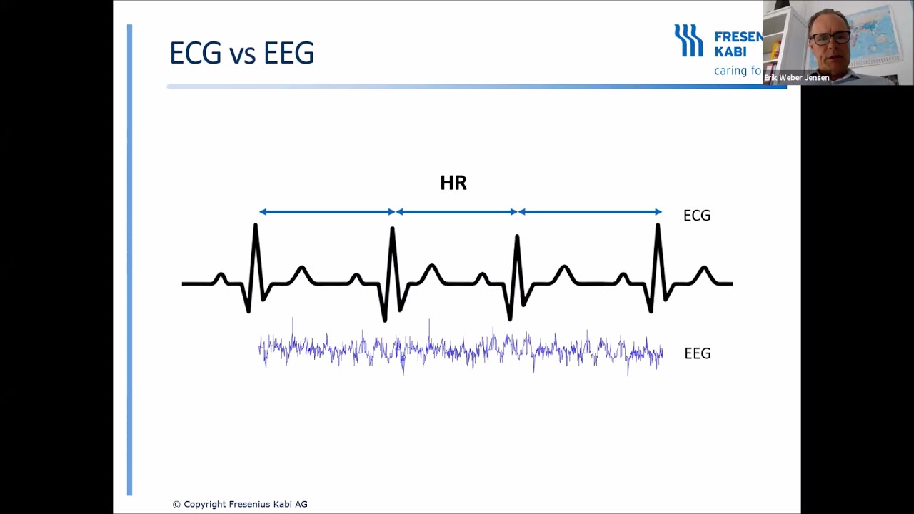 Processed EEG &ndash; The Key to Nociception Index