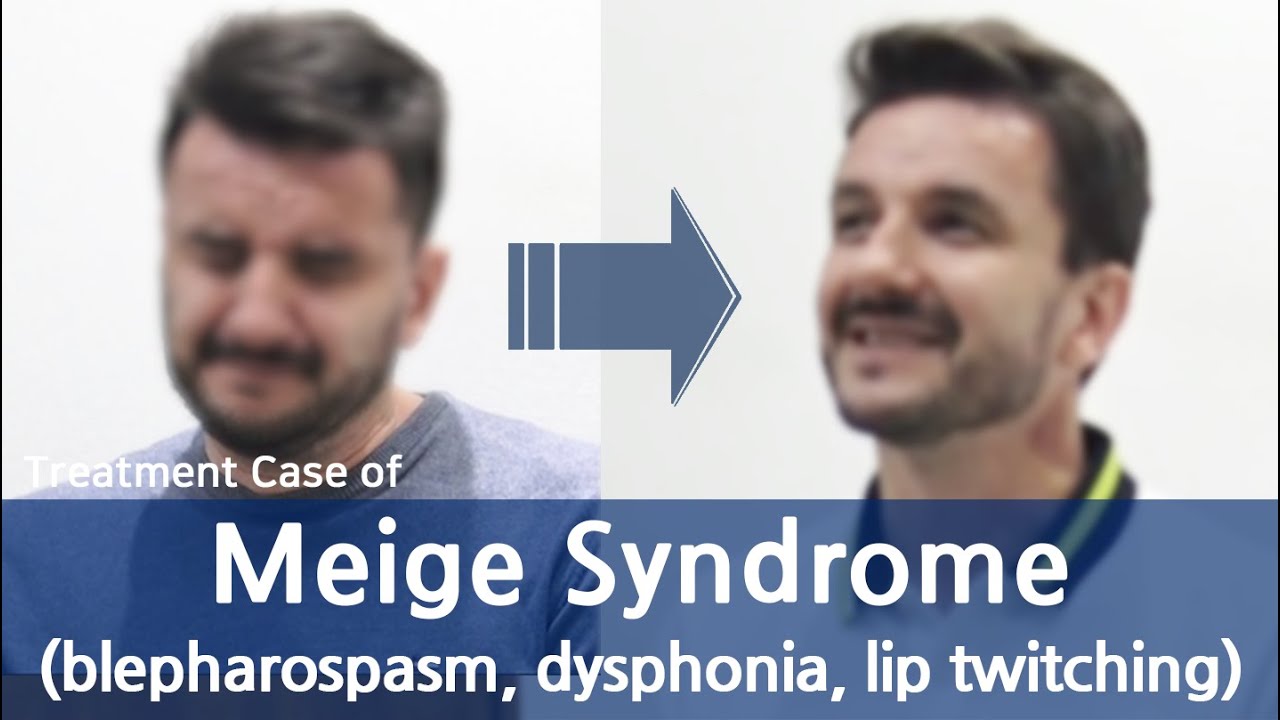 Meige syndrome / blepharospasm / dysphonia / lip twitching / 메이그 중후군 / 디스토니아 치료사례