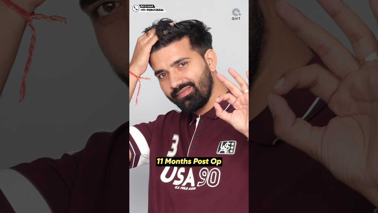 Diffuse Grade 5 Hair Transplant #qht #shortsvideo #trending #ytshortsindia #hairtransplant #hairloss