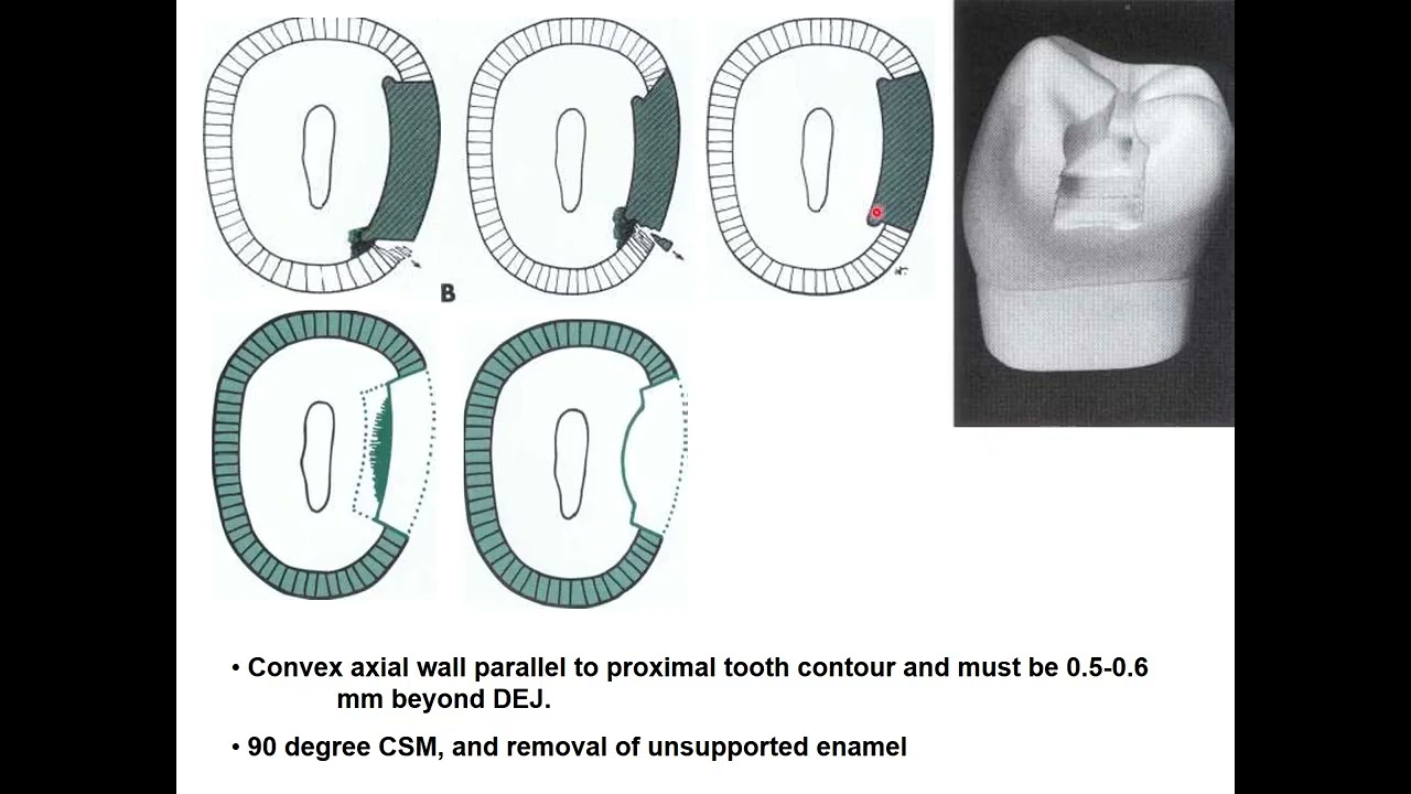 Class II cavity preparation for amalgam restoration