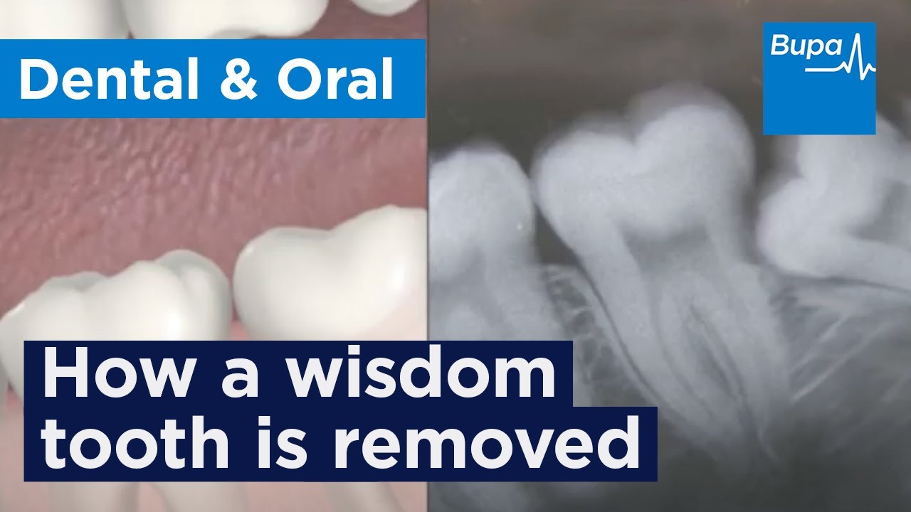 How a wisdom tooth is removed | Dental Hygiene | Bupa Health