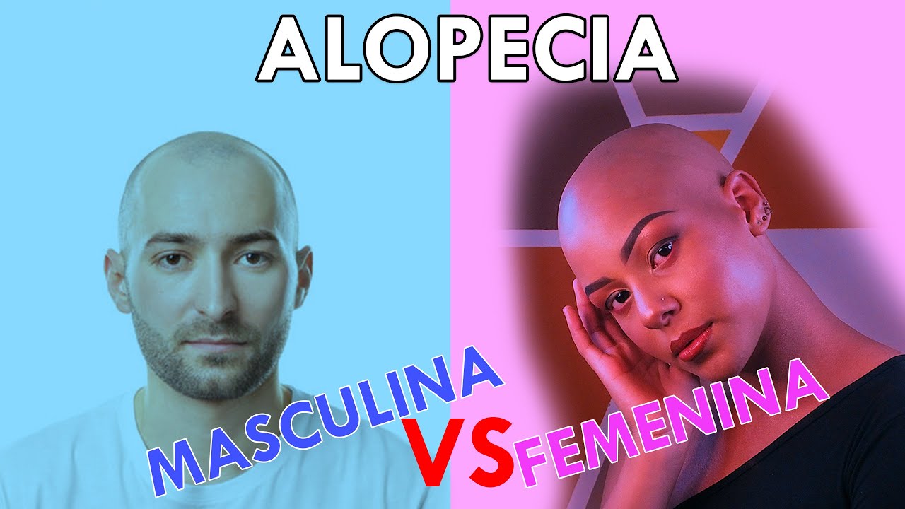 Alopecia masculina vs. femenina explicado por médico