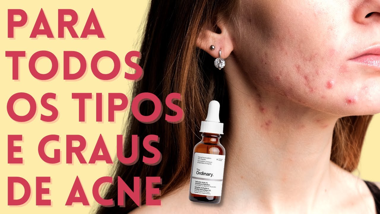 Ácido Salicílico no Tratamento da Acne | Produtos para Acne que FUNCIONAM! EP 03