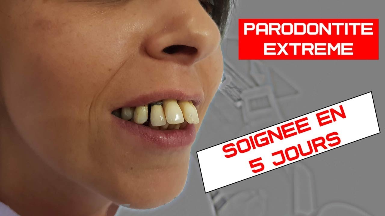 Soigner la parodontite avec perte de gencive : Implants dentaires basales (non invasif)