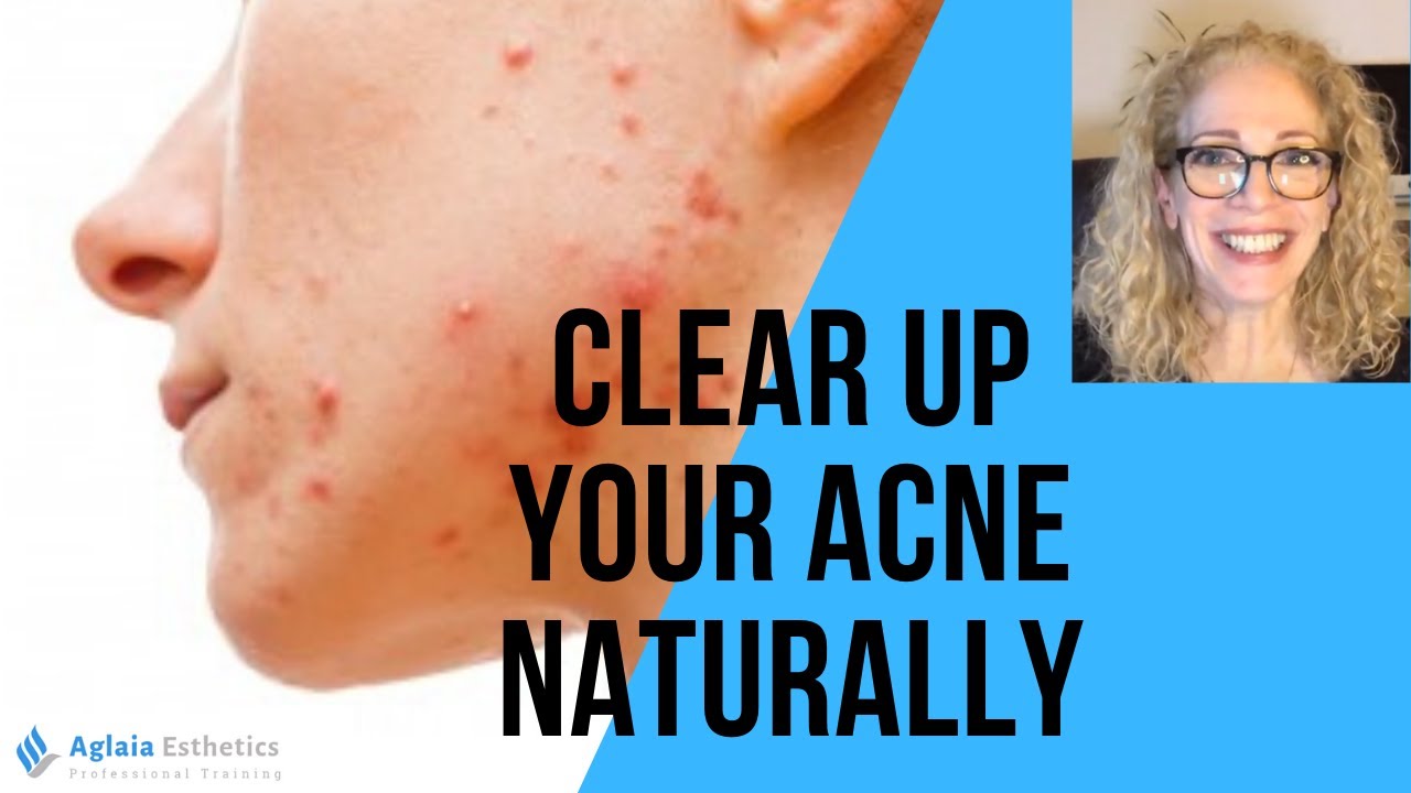 ACNE FACTS YOU NEED TO KNOW!