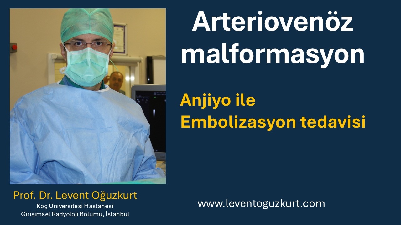 Arteriovenöz malformasyon embolizasyonu