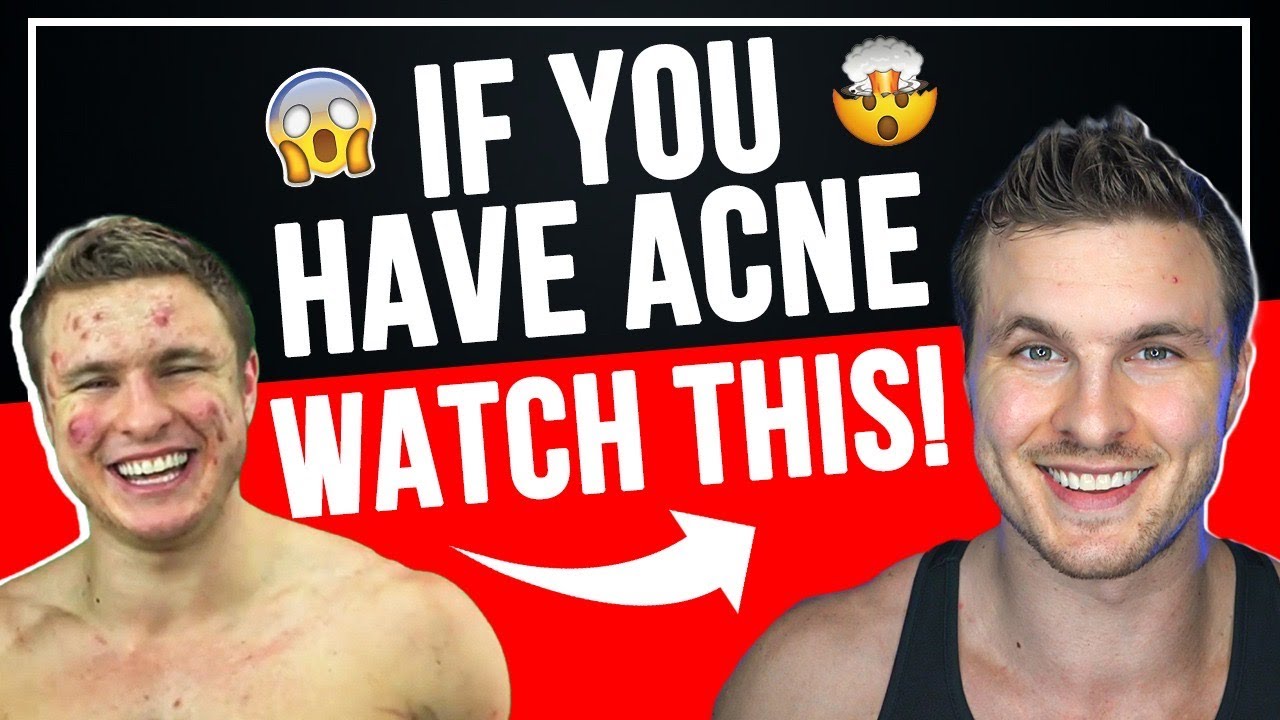 How To HACK Your Confidence With Acne!