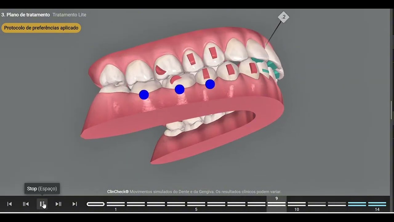 Invisalign ClinCheck: Intruding Lower Anteriors, Bite Plates & Closing Upper Gaps