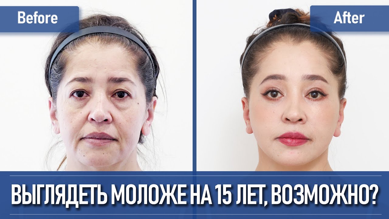 Молодость — снова в зеркале: невероятный результат омоложения после лифтинга лица в Корее