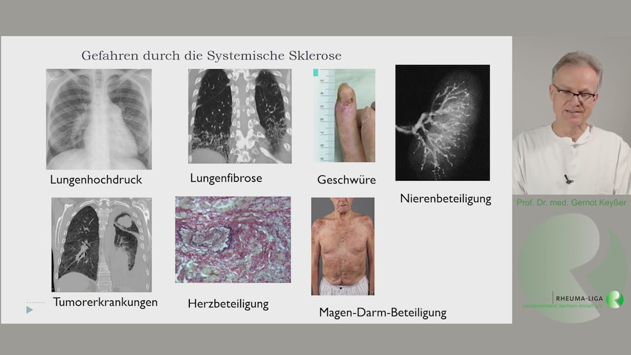Kurzvorstellung der systemischen Sklerose (Sklerodermie)