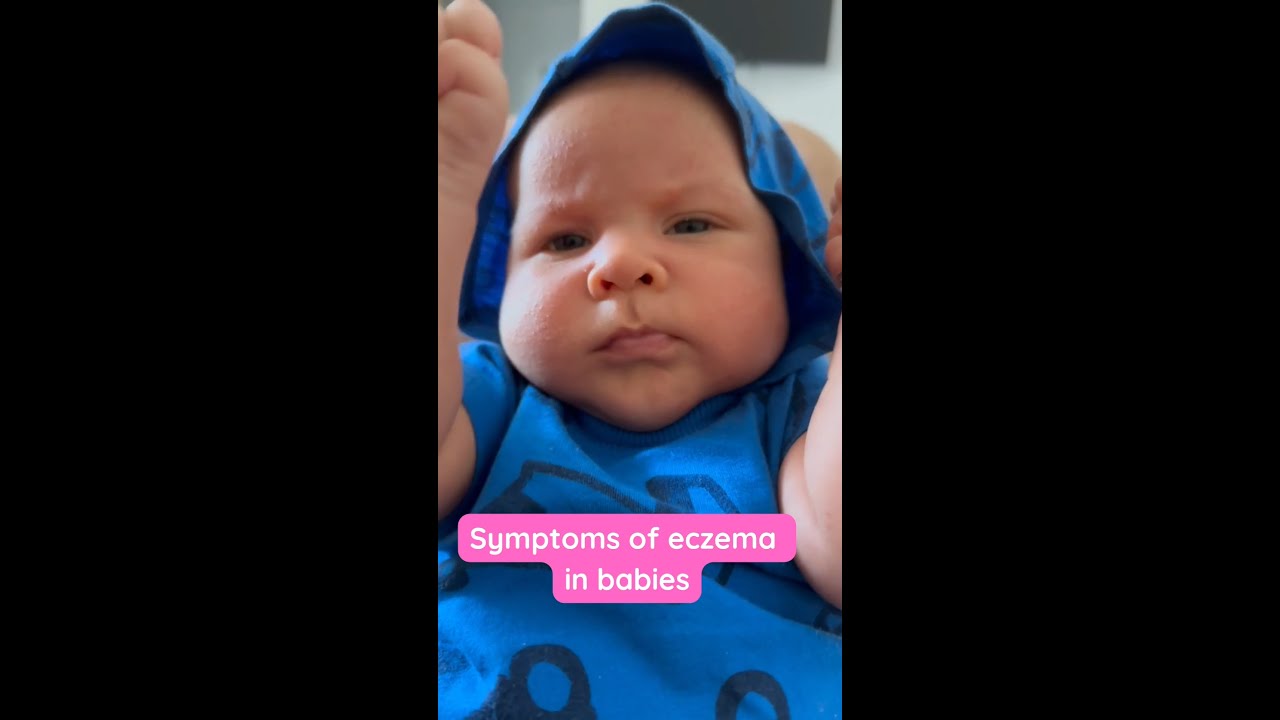 Eczema in babies & children: the causes, symptoms, and treatments