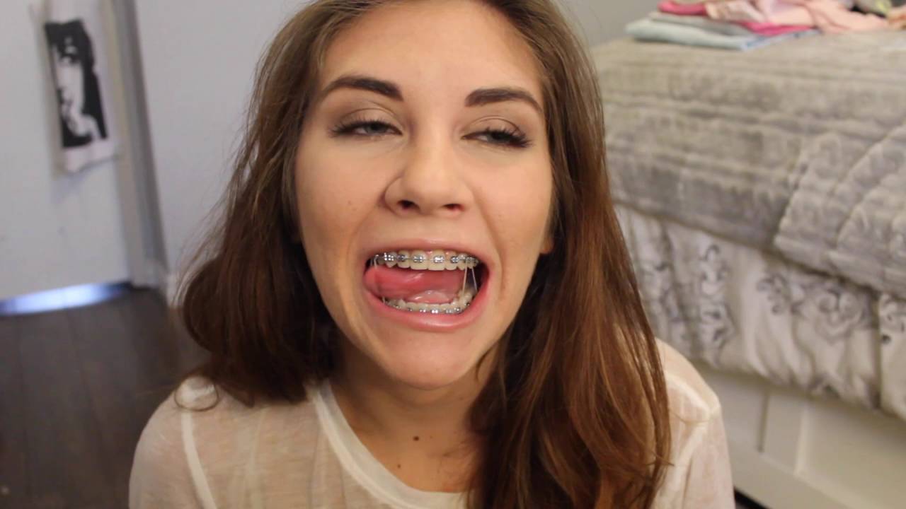 Braces & Rubberbands Video of Bracefacebeauty Victoria