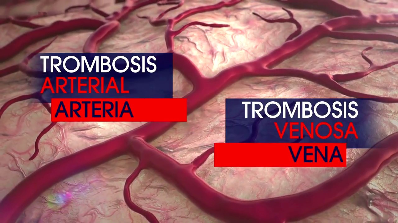 Conoce la Trombosis, Manténgase Con Vida
