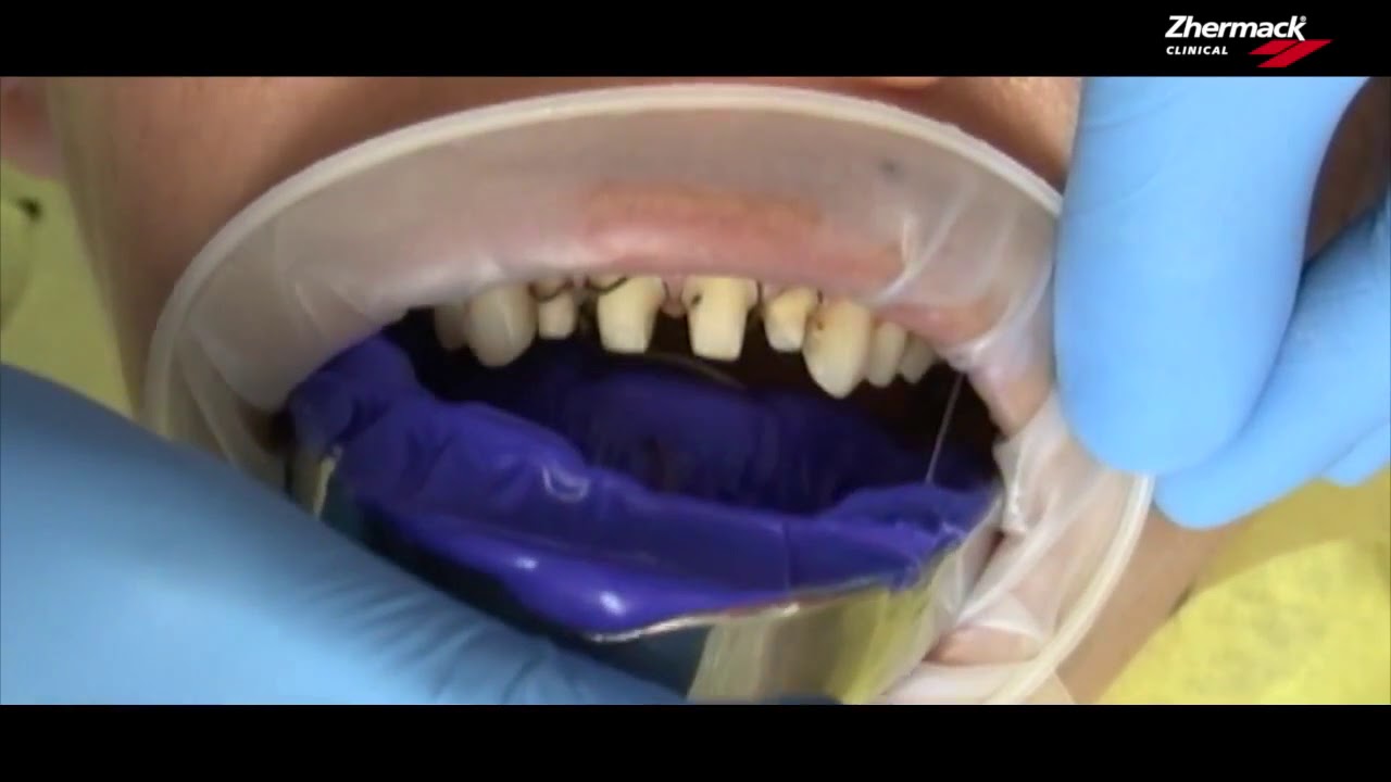 Hydrorise Video ENG   double stage impression putty extra light