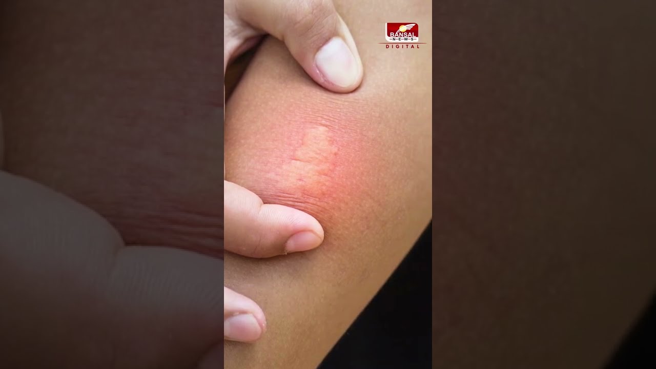 मधुमक्खी काटने पर उपचार के घरेलू नुस्खे - Honey Bee Bite Treatment | Home Remedies