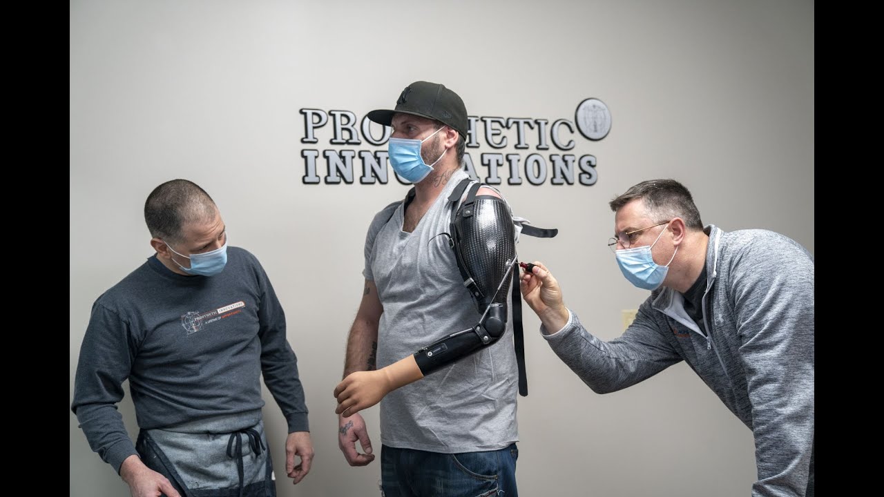 Trans-Humeral Hyrbid Myo-electric Prosthesis | Prosthetic Innovations