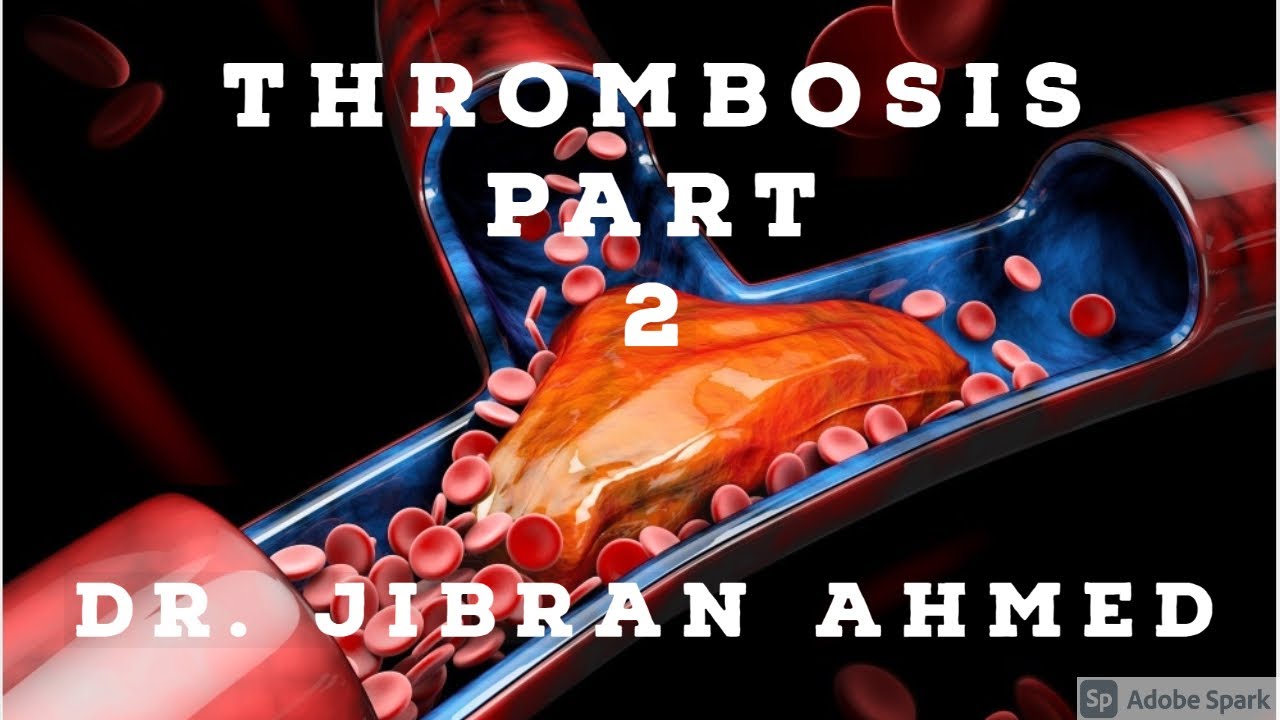 GENERAL PATHOLOGY II THROMBOSIS II PART 2 II CHAP 4 II ROBBINS 10TH EDITION