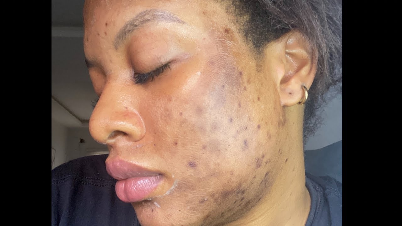 CHEMICAL PEEL | My Full Peeling Process + Review | Is It Worth It?