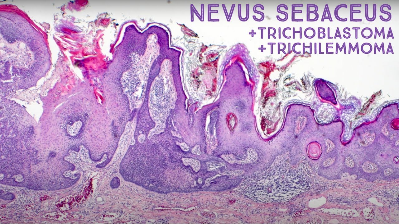 Tumors Growing from Nevus Sebaceus (Trichilemmoma & Trichoblastoma): Dermpath in 5 Minutes