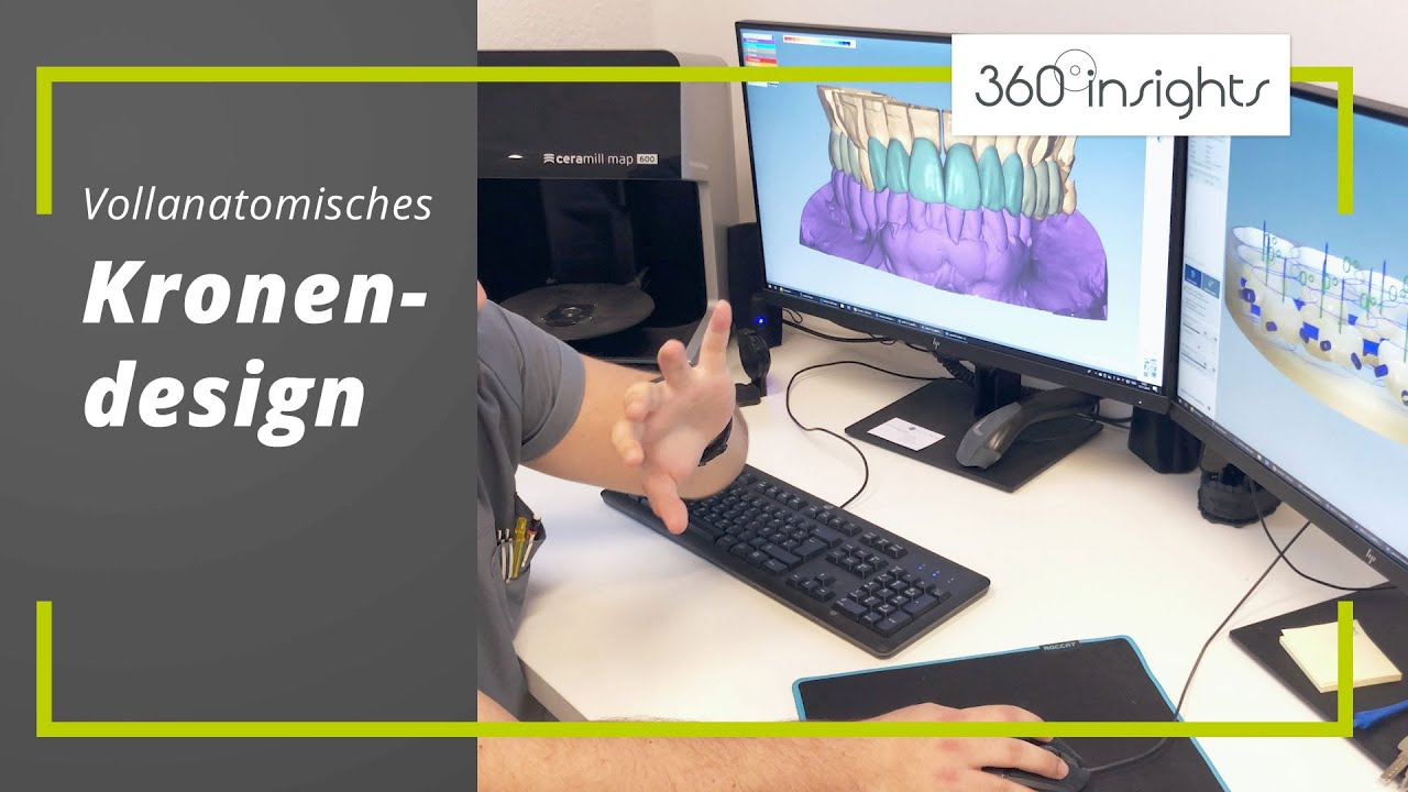 Vollanatomisches Kronendesign | 360°zahn insights